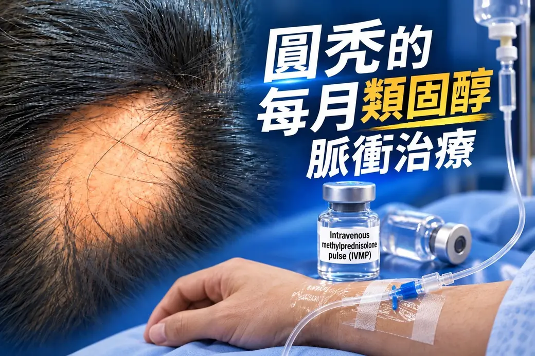 示意圖。左邊是圓禿的頭皮特寫，界線清楚的一塊沒有頭髮；右邊是靜脈注射中的手背與標示 intravenous methylprednisolone pulse（IVMP）的藥瓶；主標「圓禿的每月類固醇脈衝治療」