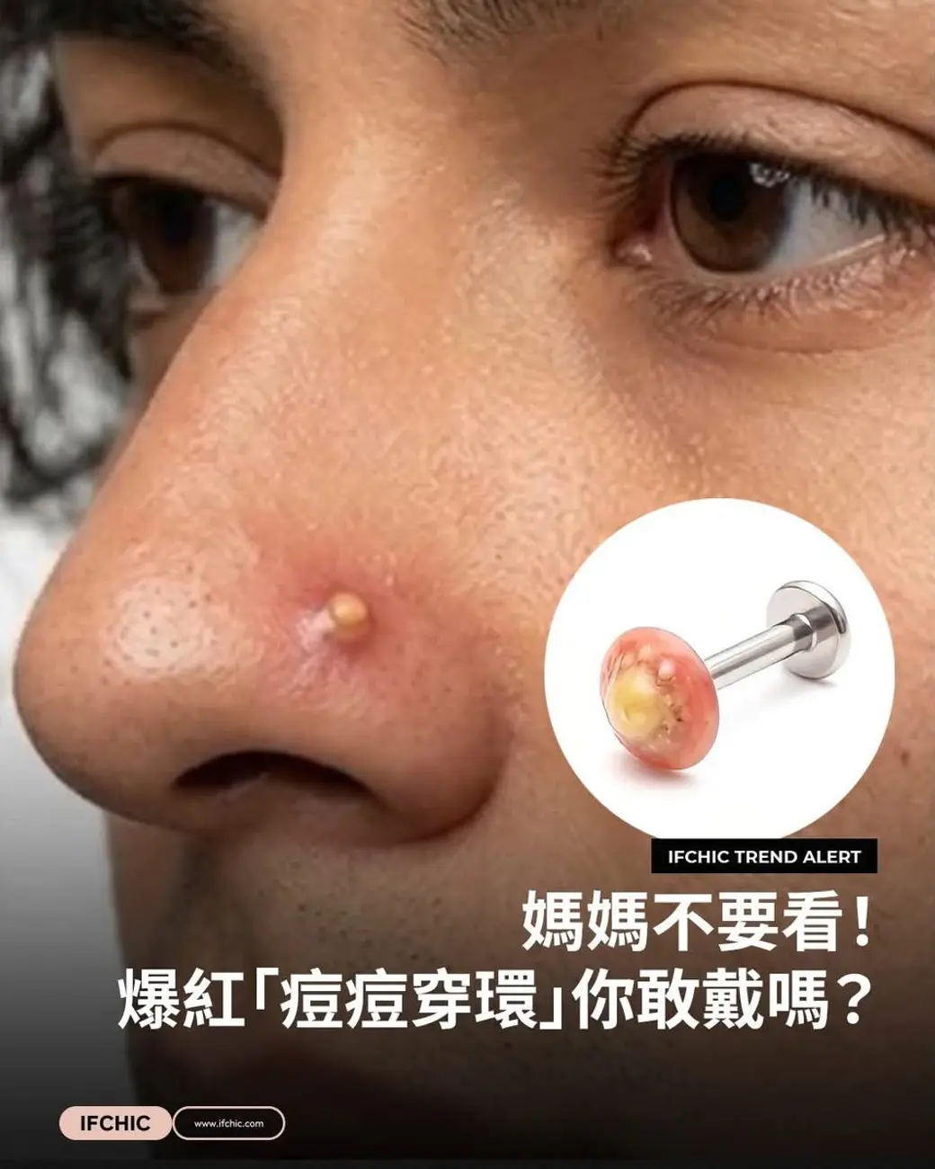 社群貼文圖，鼻翼旁一顆膿皰的臉部特寫，右下角圓形小圖是一支穿過膿皰的裝飾耳環，畫面上印著「媽媽不要看！爆紅『痘痘穿環』你敢戴嗎？」。