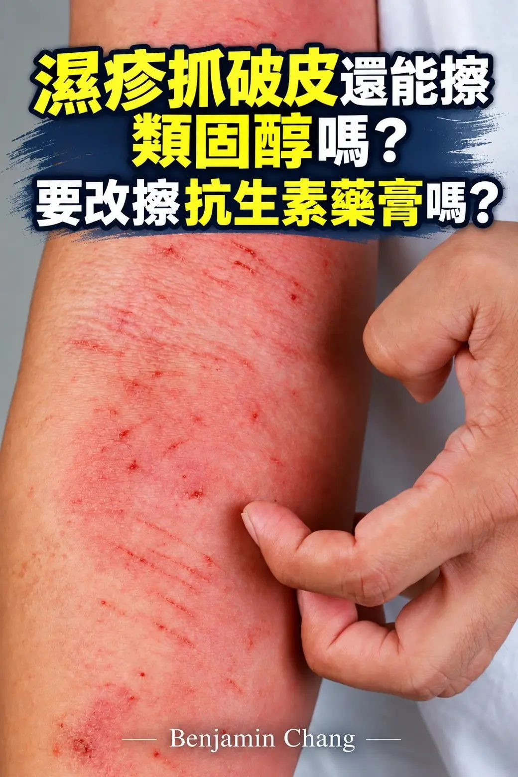 直式封面。畫面中央是一段前臂，皮膚上有幾片泛紅的濕疹，上面布滿細細的線狀抓痕，抓痕間有幾個很小的血點；另一隻手從畫面右側伸過來，正在抓那片皮膚。畫面沒有人臉。上方是大字標題「濕疹抓破皮還能擦類固醇嗎？要改擦抗生素藥膏嗎？」，底部署名「— Benjamin Chang —」。