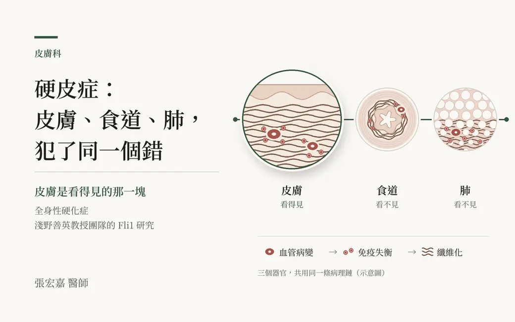示意圖：皮膚、食道、肺三個組織剖面，以一條線串起，各自出現血管病變、免疫細胞與纖維化；左側為標題文字