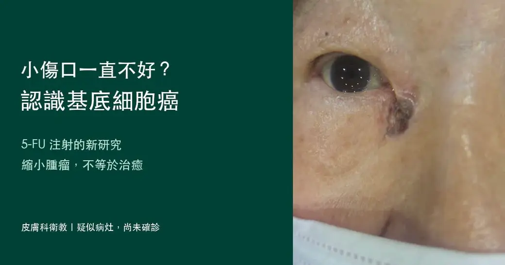 左側為基底細胞癌與 5-FU 研究的衛教標題，右側為經當事人同意的眼內側附近病灶照片；標示疑似病灶、尚未確診。