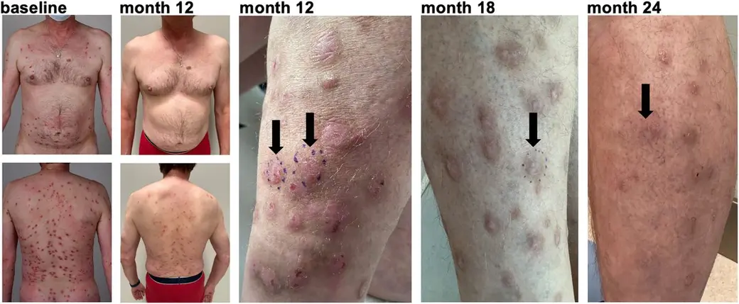 期刊臨床照片組，依 baseline、month 12、month 18、month 24 排列的軀幹與四肢照片，箭頭指向逐次變化的丘疹與結節病灶。