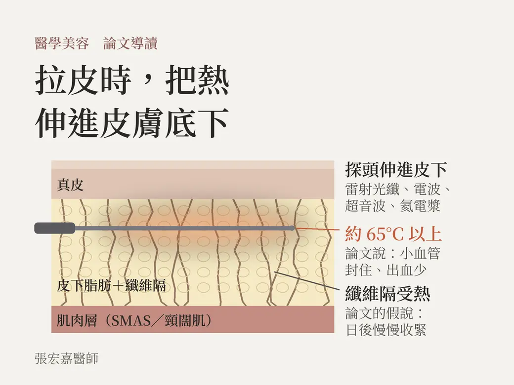 機轉示意封面「拉皮時，把熱伸進皮膚底下」：一張皮膚剖面，由上到下是真皮、皮下脂肪與縱向的纖維隔、肌肉層（SMAS／頸闊肌）；一支細長探頭從左邊水平伸進皮下脂肪層，周圍一圈橘色熱區。右側三行說明：探頭伸進皮下（雷射光纖、電波、超音波、氦電漿）；約 65°C 以上，論文說小血管封住、出血少；纖維隔受熱，論文的假說是日後慢慢收緊。