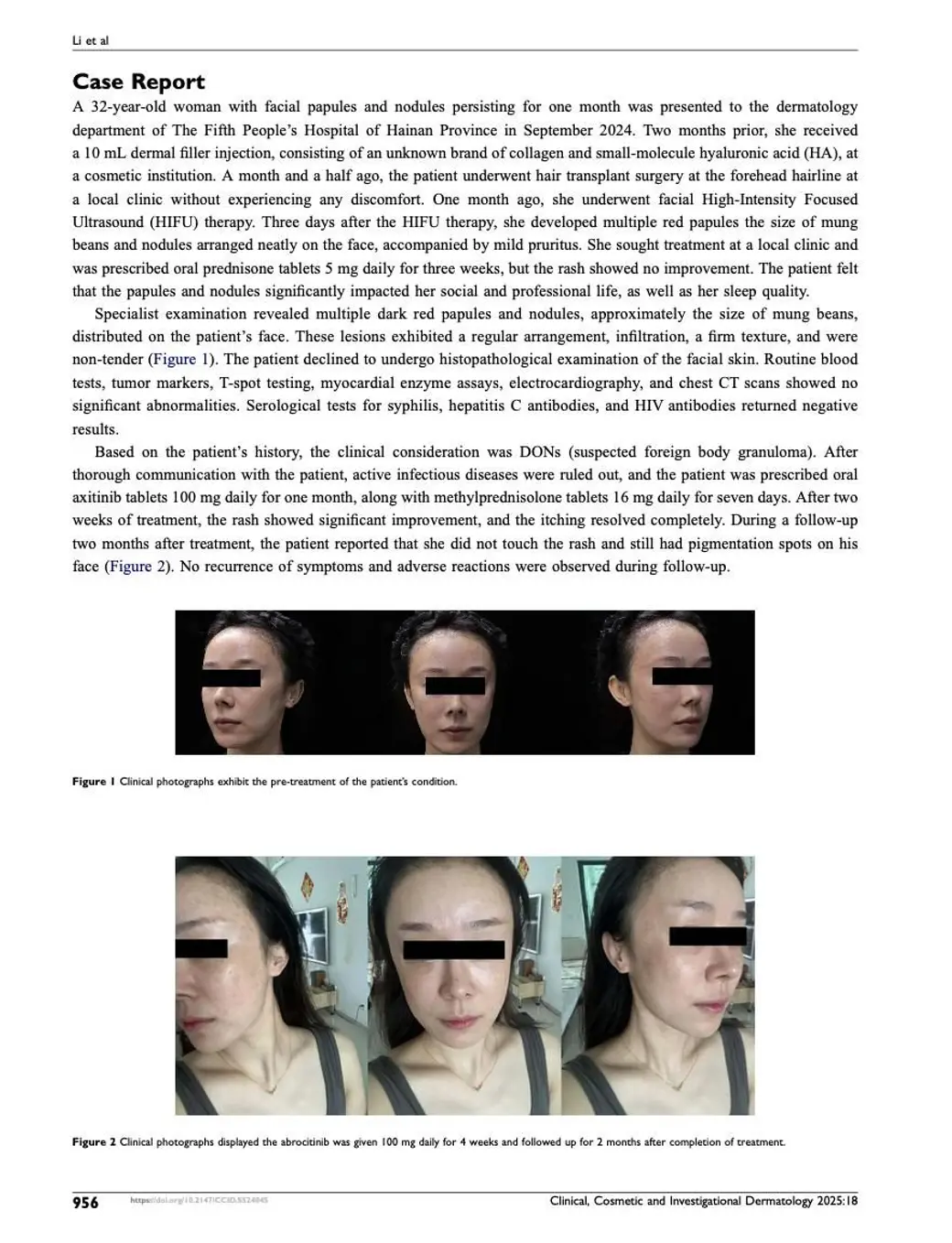 期刊個案報告翻拍，上半是英文病例敘述，下方 Figure 1 與 Figure 2 各三張臉部照片，眼部已用黑條遮蔽，顯示面部丘疹結節在治療前後的變化。
