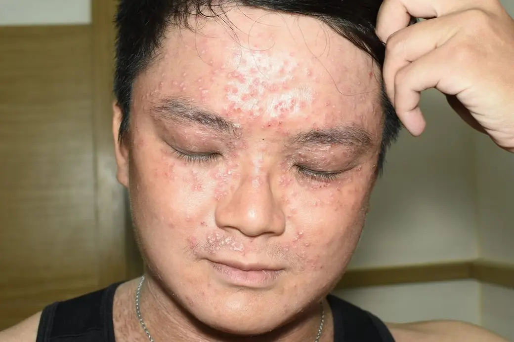 臨床照片，一位男性抬手抓頭，額頭、眼周與臉頰佈滿密集的紅色丘疹與脫屑。