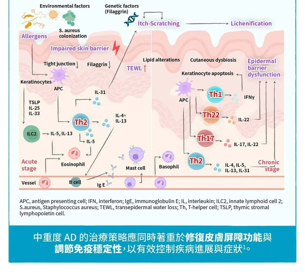 期刊示意圖，左右兩半分別是急性期與慢性期的異位性皮膚炎皮膚剖面，標示屏障受損、Th2／Th1／Th17／Th22 細胞與各種細胞激素，下方藍色橫幅是中文結論句。