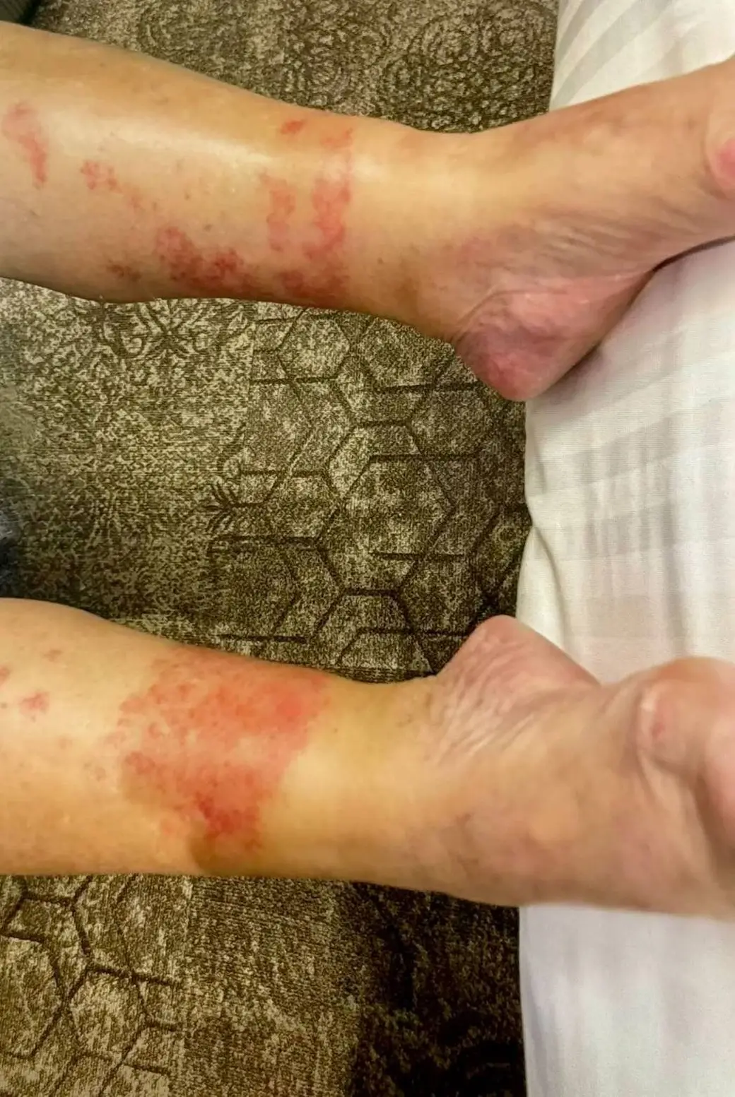 一位病人用手機拍下的雙腿，兩條小腿下段到腳踝各有一片不規則的紅斑與紅點，左右對稱；紅斑在腳踝上方、大約襪口的高度整齊停住，以下的腳背與腳跟膚色正常。背景是深色花紋地毯與白色床單。