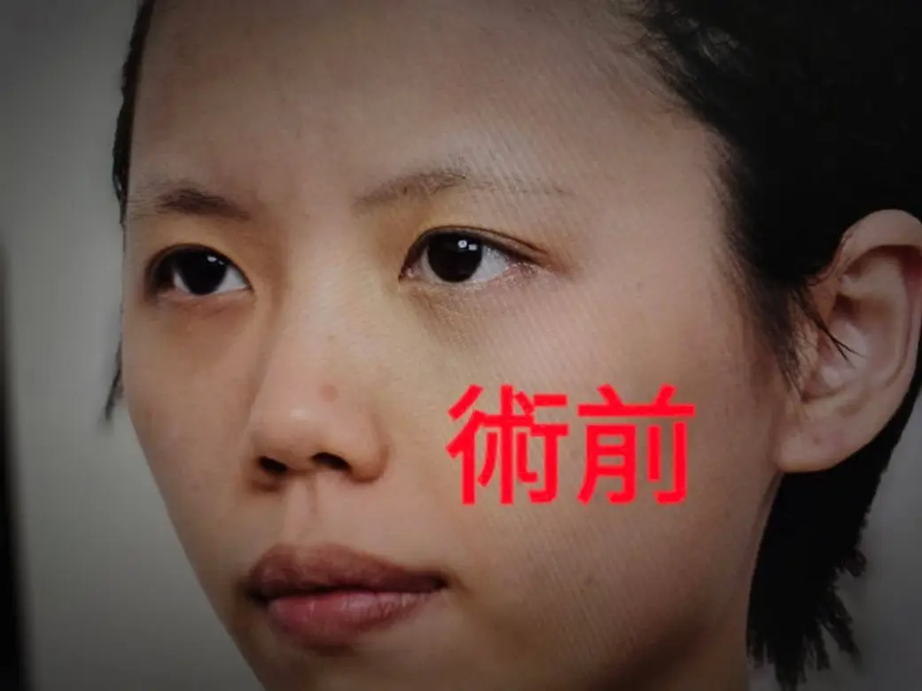 臨床照片，一位女性的四分之三側臉，畫面上以紅色字標著「術前」。