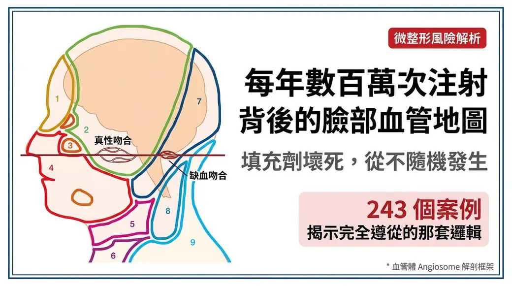 自製圖卡，左側是頭頸部血管分區的彩色解剖圖，標示真性吻合與缺血吻合的位置，右側是中文標題與「243 個案例」的紅色數字方塊。