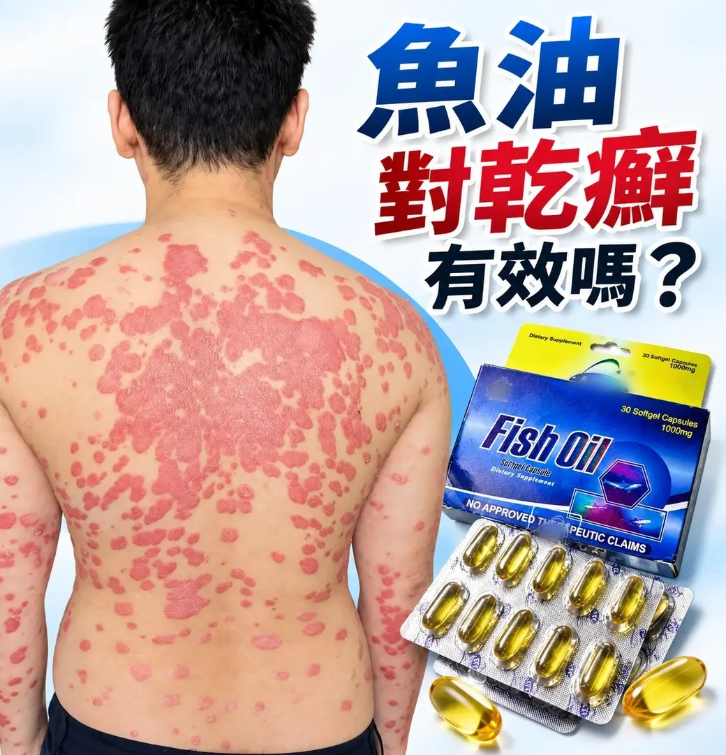 示意圖。左邊是一位男性的背部，佈滿乾癬的紅色厚斑塊；右邊是一盒魚油軟膠囊與一板膠囊；上方主標「魚油對乾癬有效嗎？」