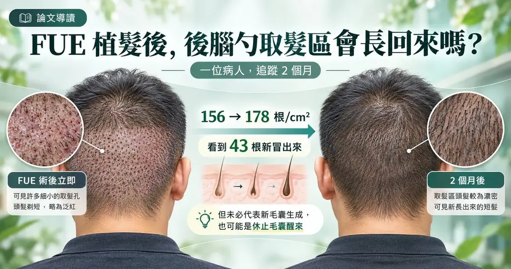 AI 生成的示意圖，左右兩張男性後腦勺。左邊標「FUE 術後立即」，頭髮剃短、取髮區布滿細小的取髮孔；右邊標「2 個月後」，取髮區可見新長出的短髮。中間寫每平方公分 156 根變 178 根、看到 43 根新冒出來，並註明未必代表新毛囊生成，也可能是休止毛囊醒來。