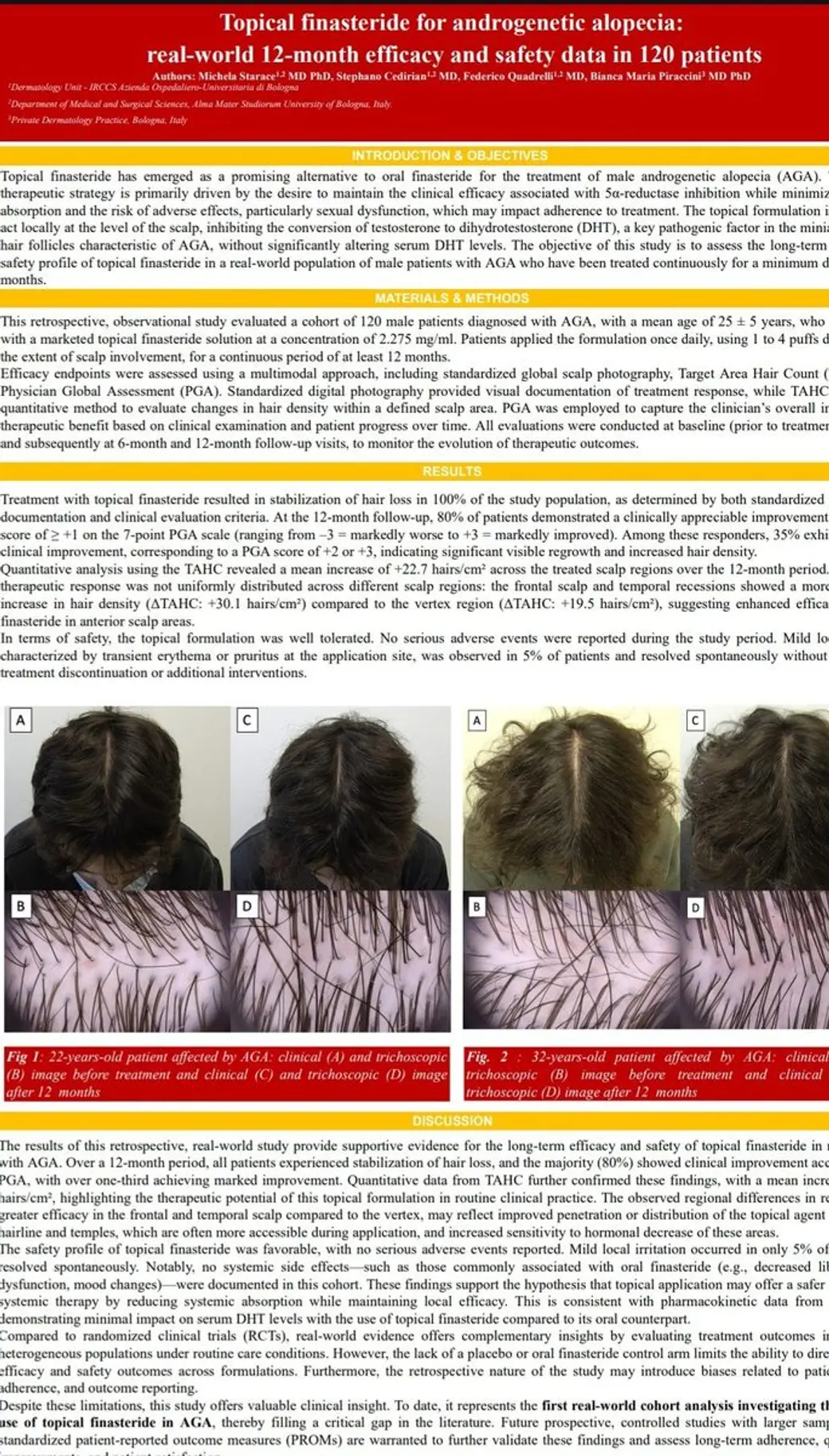 學術海報翻拍，標題為外用 finasteride 治療雄性禿的 120 人 12 個月真實世界資料，內文分成前言、材料方法、結果、討論，中間是兩名患者治療前後的頭頂照片與毛髮鏡影像。