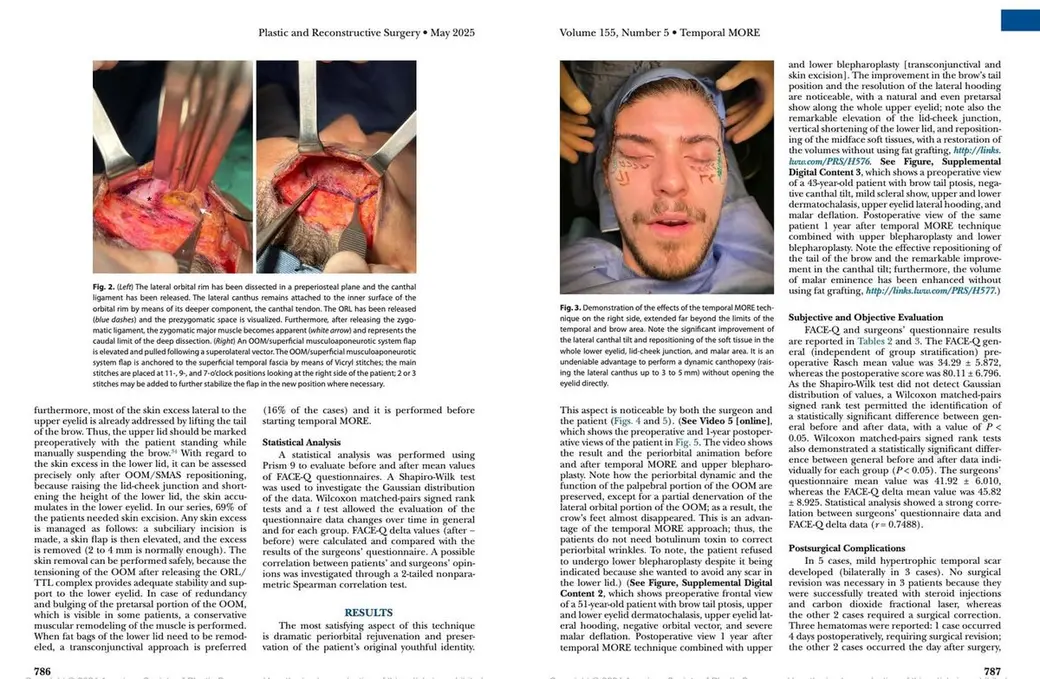 期刊跨頁翻拍，左頁是兩張眼周手術中的解剖照片，右頁是一位病人術後的臉部照片與英文內文。