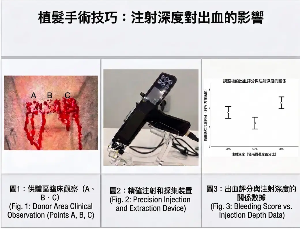 植髮手術技巧：注射深度對出血的影響。供體區臨床觀察、精確注射裝置，以及出血評分與注射深度的關係。