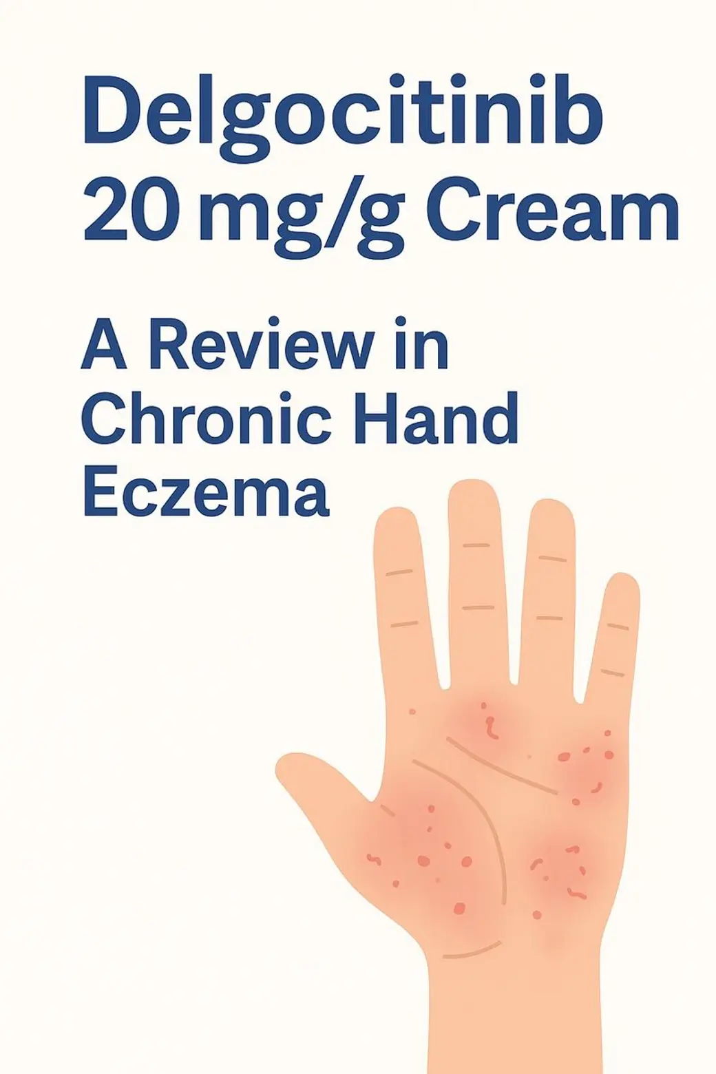 圖卡，米色底，上方藍色大字寫著 Delgocitinib 20 mg/g Cream 與 A Review in Chronic Hand Eczema，下方是一隻手掌的插畫，掌面有成片紅色丘疹。