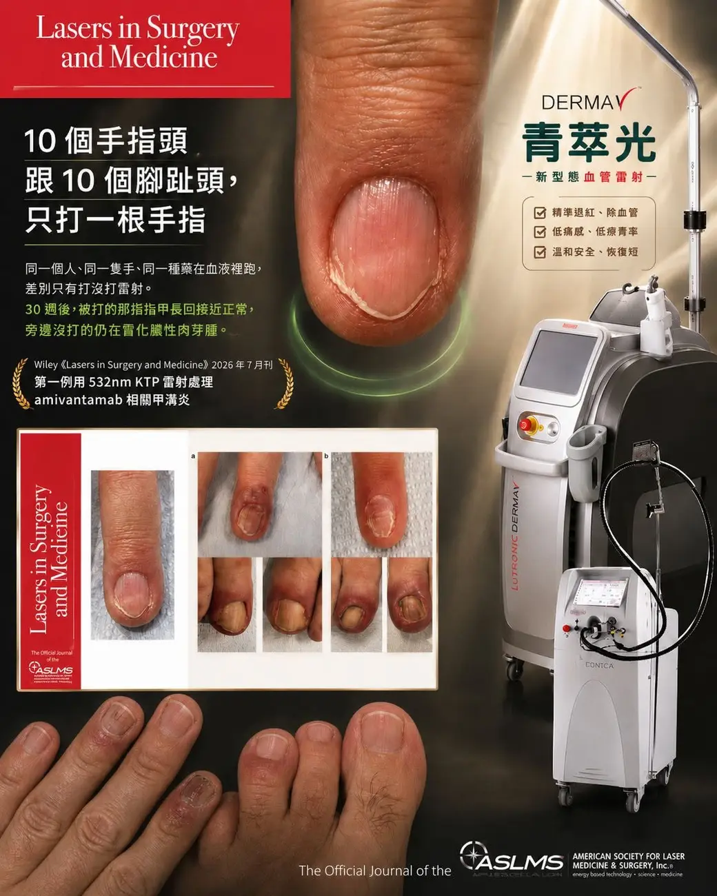Lasers in Surgery and Medicine 2026 年 7 月刊——第一例用 532nm KTP 雷射處理 amivantamab 相關甲溝炎。