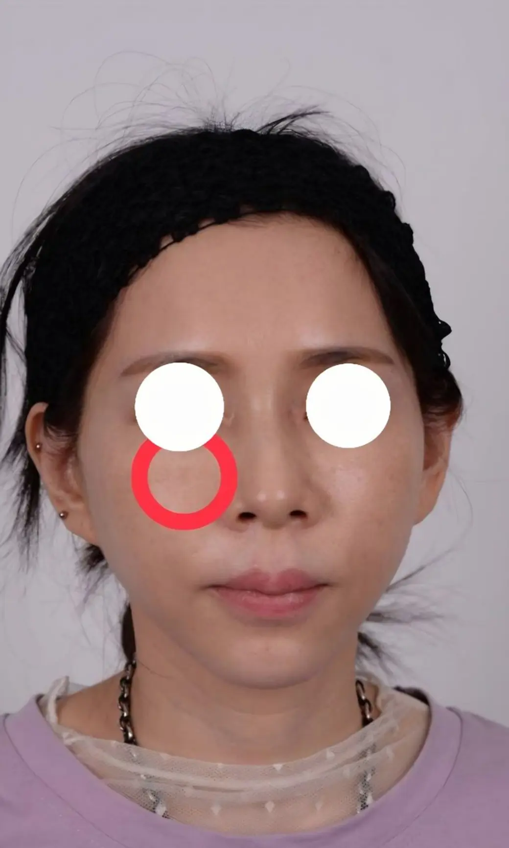 臨床照片，一位女性的正面臉部，雙眼以白色圓形遮蔽，左臉頰上用紅色圓圈標出一處範圍。