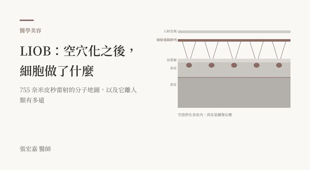 排版式封面。左半是「醫學美容」分類標籤與標題「LIOB：空穴化之後，細胞做了什麼」；右半是作者自繪的 LIOB 示意圖——入射光斑、繞射透鏡陣列、五束聚焦光錐收斂到表皮內的空泡，下方依序是角質層、表皮、真皮三層，表皮與真皮交界畫一條線，真皮內以水平虛線表示續發反應。