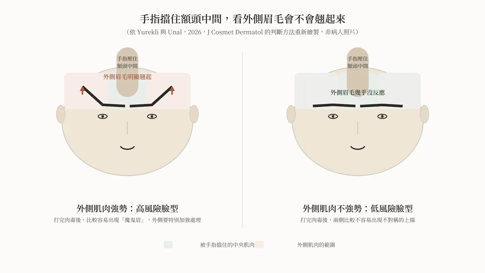 示意圖：兩張正面臉的對照。左邊手指壓住額頭中間，外側眉毛明顯翹起，標示為高風險臉型；右邊同樣手指壓住中間，外側眉毛幾乎沒反應，標示為低風險臉型；圖說註明依論文的判斷方法重新繪製，不是病人照片。