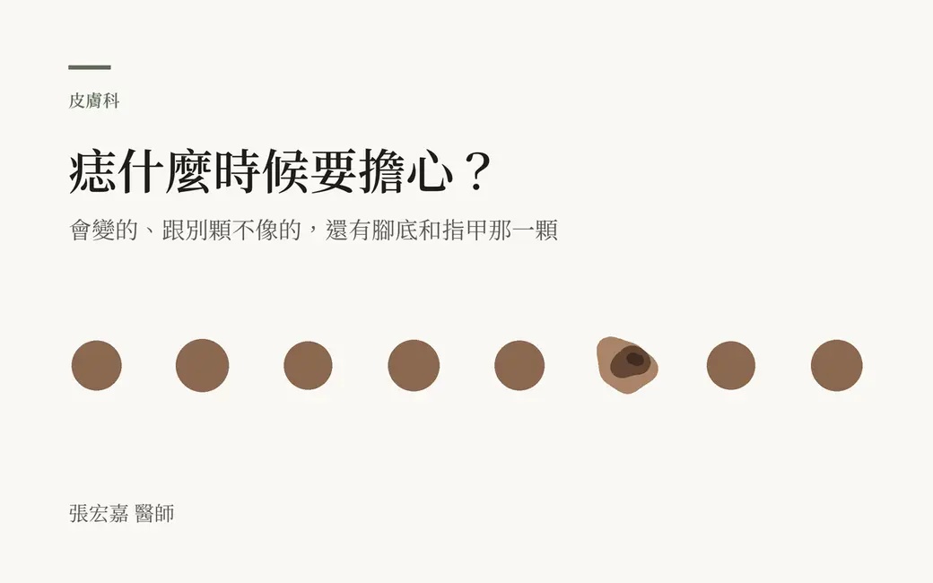 排版式文字封面，淺色底，主標「痣什麼時候要擔心？」。下方一排大小相近、顏色一致的褐色圓點，其中只有一顆形狀歪斜、顏色深淺不一，示意「跟其他痣都不像的那一顆」。左下角署名張宏嘉醫師。畫面沒有人臉、真實病灶照片或數字。