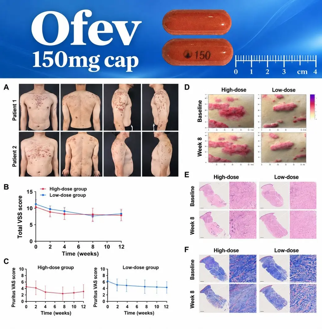 Ofev（nintedanib）150 mg 膠囊，以及泛發性蟹足腫先導研究的病人照片、VSS 與搔癢評分變化、組織切片。圖片引自 Liu et al., J Cosmet Dermatol 2026 及藥品資料。