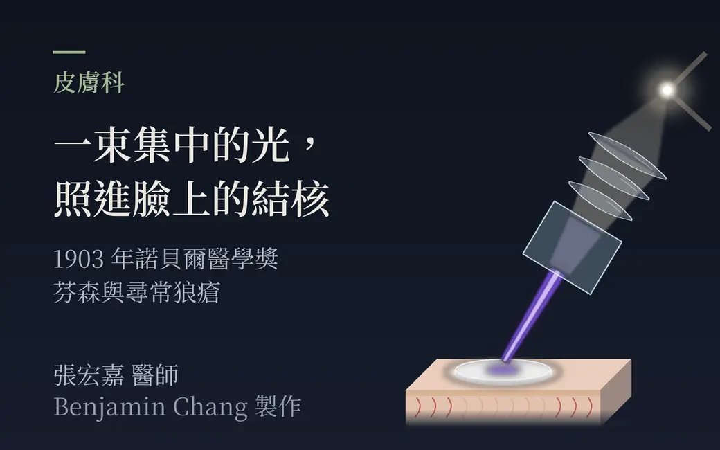 深藍近黑的背景上，右側是一盞示意的碳弧燈：一點刺眼的白色電弧，光往左下穿過一排三片透鏡，再經過一個裝著淡藍色濾液的長方形容器，收成一道細細的藍紫色光束，落在一片圓形的透明壓片上；壓片底下是一小塊被壓到發白的淺色皮膚，畫面裡沒有人臉。左側是主標「一束集中的光，照進臉上的結核」與副標「1903 年諾貝爾醫學獎，芬森與尋常狼瘡」，左下署名張宏嘉醫師，並註明「Benjamin Chang 製作」。