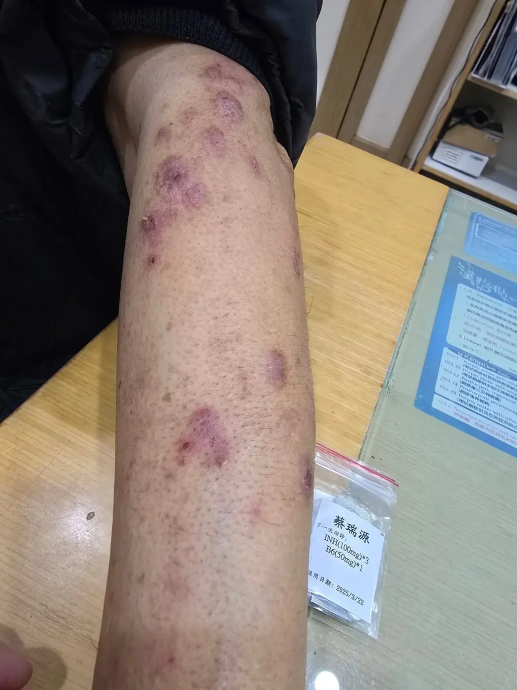 臨床照片，一條小腿上散佈著大小不一的紫紅色瘀斑與色素沉澱，旁邊桌上放著一包藥袋。