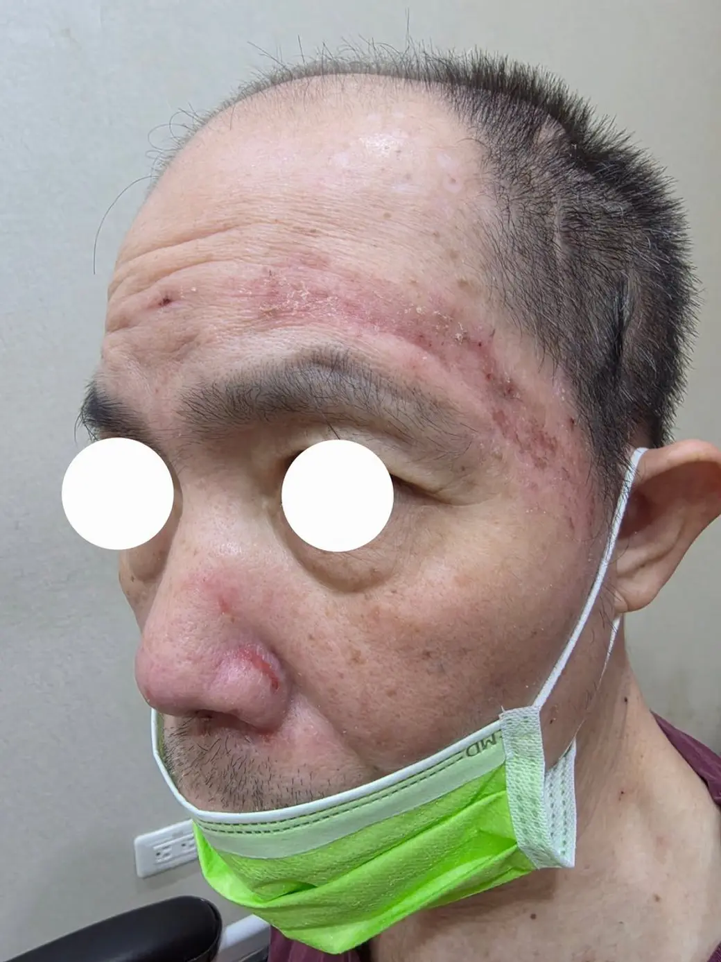 臨床照片，一位長者的額頭與上眼瞼有一片結痂紅疹沿著單側分布，雙眼以白色圓形遮蔽，下巴掛著口罩。