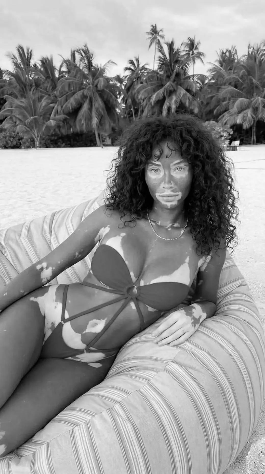 黑白照片，一位捲髮女性穿泳裝斜倚在海邊的躺椅上，臉部、胸口與四肢有大片邊界清楚的脫色斑，背景是椰子樹與白沙灘。