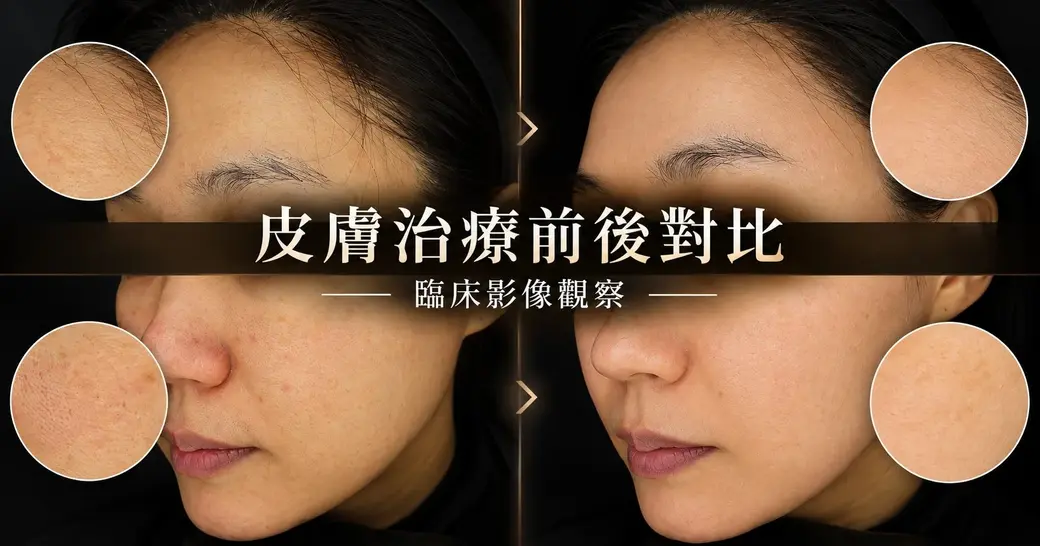 同一位女性左右並排的側臉臨床照片，眼睛以深色遮蔽去識別化；左為治療前、右為治療後，四個圓形放大框分別是額頭與臉頰的毛孔、紅點與膚色細節；中央大字「皮膚治療前後對比」、副標「臨床影像觀察」。