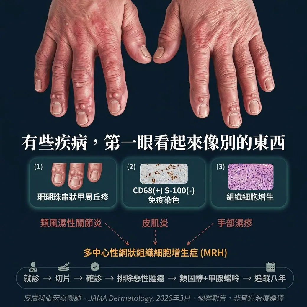 自製圖卡，上半是一雙手背的照片，指節周圍有成串的小丘疹；下半以三個方框列出臨床、免疫染色與病理發現，箭頭指向三個易混淆的診斷與最終診斷，最下方是就診到追蹤的流程與出處註記。
