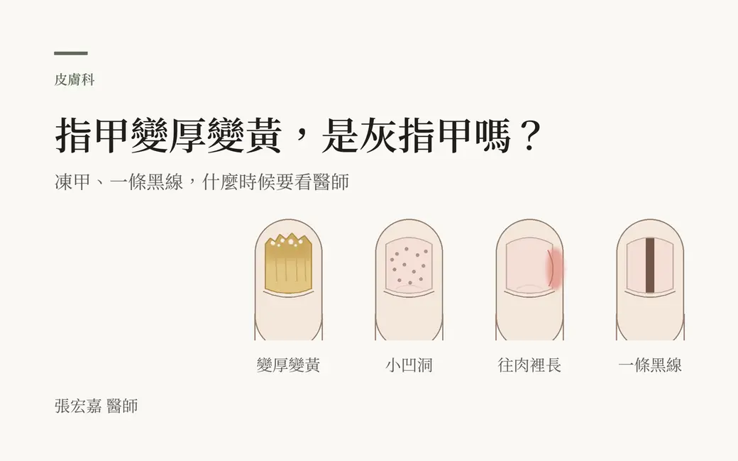 排版式封面，淺色底，左上「皮膚科」與主標「指甲變厚變黃，是灰指甲嗎？」，副標「凍甲、一條黑線，什麼時候要看醫師」。右下四根腳趾的俯視線稿：第一根的指甲變黃、前緣碎成鋸齒，標「變厚變黃」；第二根的指甲上有一個個小點，標「小凹洞」；第三根的指甲右側邊緣旁的肉微微泛紅，標「往肉裡長」；第四根的指甲中間有一條直直的褐黑色線，標「一條黑線」。左下角署名張宏嘉醫師。全部是自繪示意圖，沒有真實照片、產品或數字。