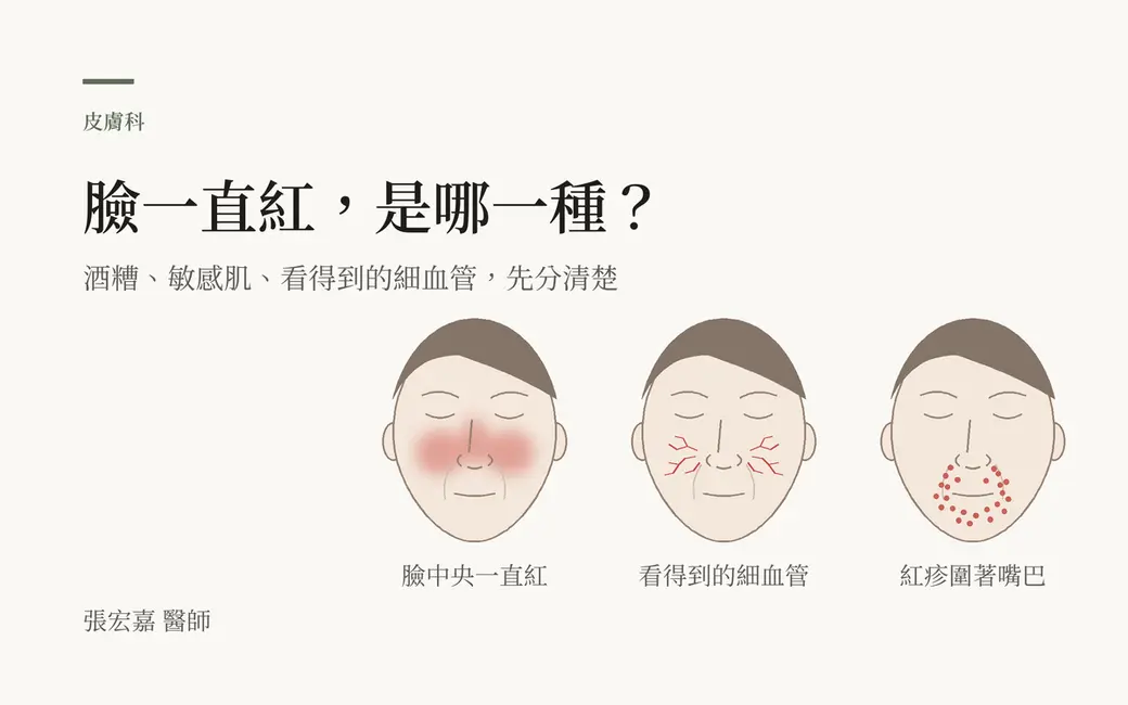 排版式封面，淺色底，左上「皮膚科」與主標「臉一直紅，是哪一種？」，副標「酒糟、敏感肌、看得到的細血管，先分清楚」。右下三張閉著眼睛的示意臉孔線稿：第一張鼻子與兩頰中間泛著一片淡紅，標「臉中央一直紅」；第二張兩頰、鼻翼旁有幾條細細的紅線，標「看得到的細血管」；第三張嘴巴周圍散著紅色小點，標「紅疹圍著嘴巴」。左下角署名張宏嘉醫師。全部是自繪示意圖，沒有真人照片、產品或數字。