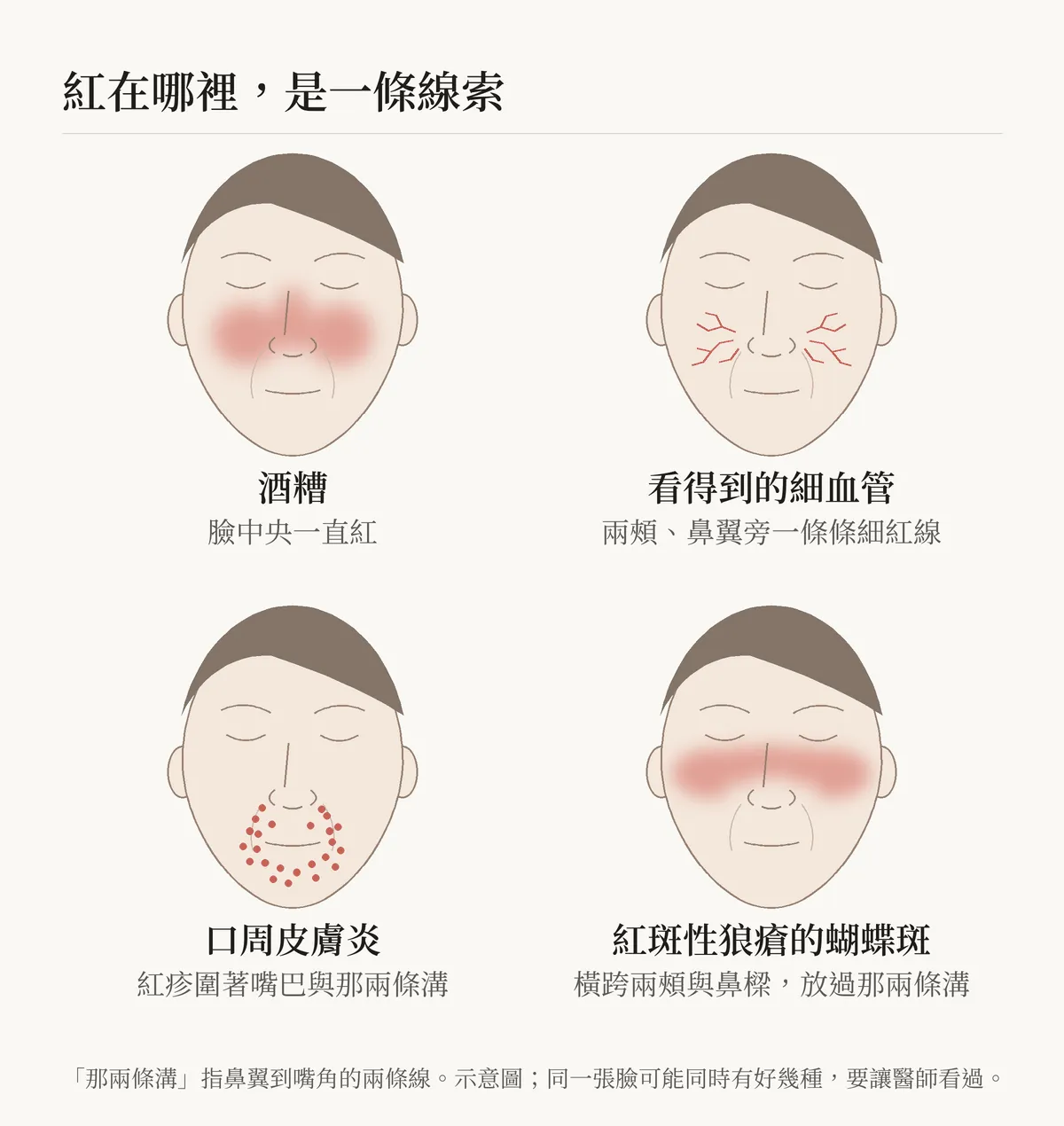 示意圖，標題「紅在哪裡，是一條線索」。四張閉著眼睛的臉孔線稿排成兩排：酒糟，鼻子與兩頰中間一片淡紅，寫著「臉中央一直紅」；看得到的細血管，兩頰與鼻翼旁幾條細紅線，寫著「兩頰、鼻翼旁一條條細紅線」；口周皮膚炎，紅色小點散在嘴巴周圍與鼻翼到嘴角的兩條溝，寫著「紅疹圍著嘴巴與那兩條溝」；紅斑性狼瘡的蝴蝶斑，一片淡紅橫跨兩頰與鼻樑，鼻翼到嘴角的兩條溝留白，寫著「橫跨兩頰與鼻樑，放過那兩條溝」。底下註明「那兩條溝」指鼻翼到嘴角的兩條線；這是示意圖，同一張臉可能同時有好幾種，要讓醫師看過。