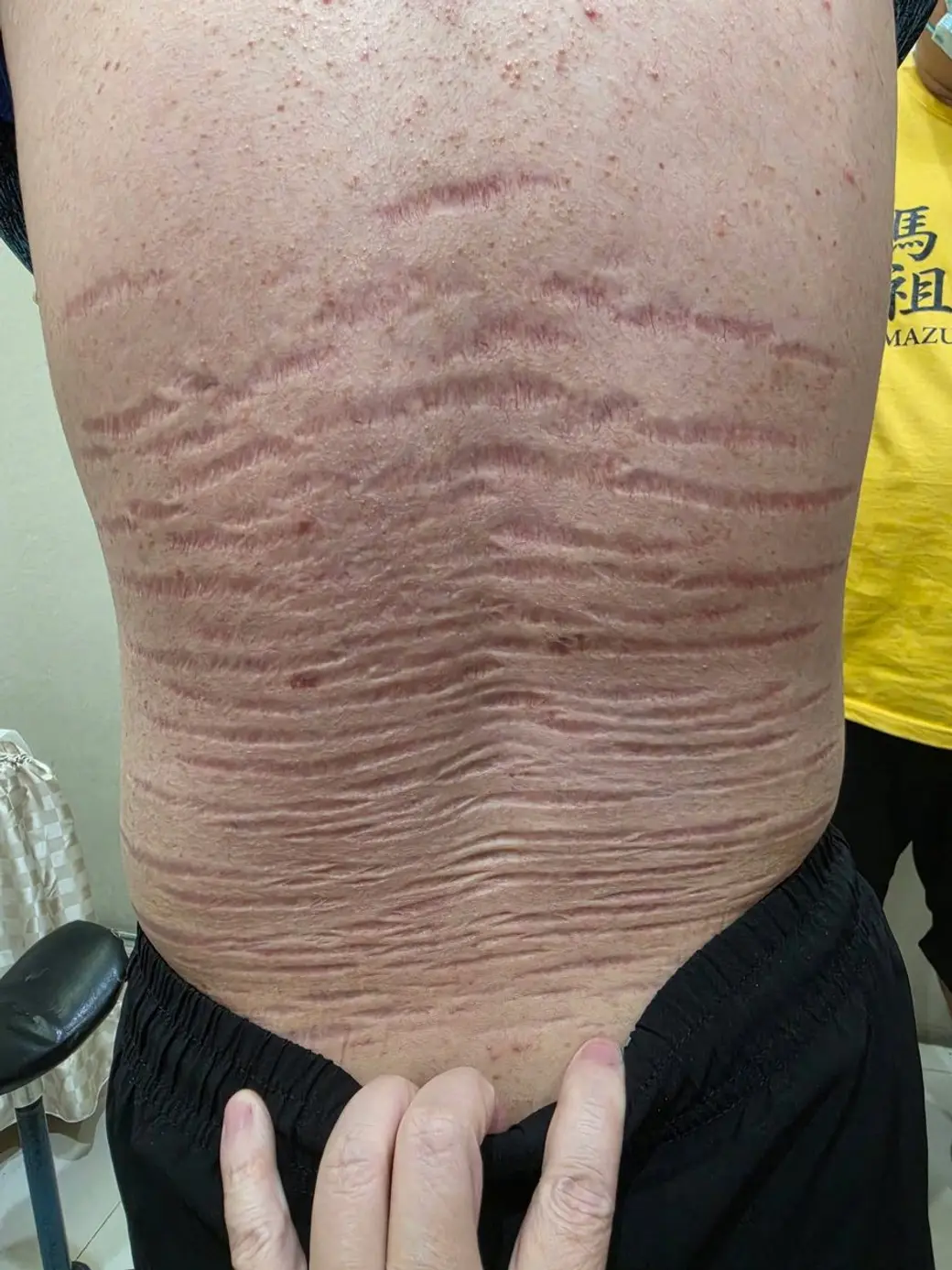 臨床照片，一個人的腰腹部，皮膚上佈滿大量平行、寬而發紅的萎縮紋。