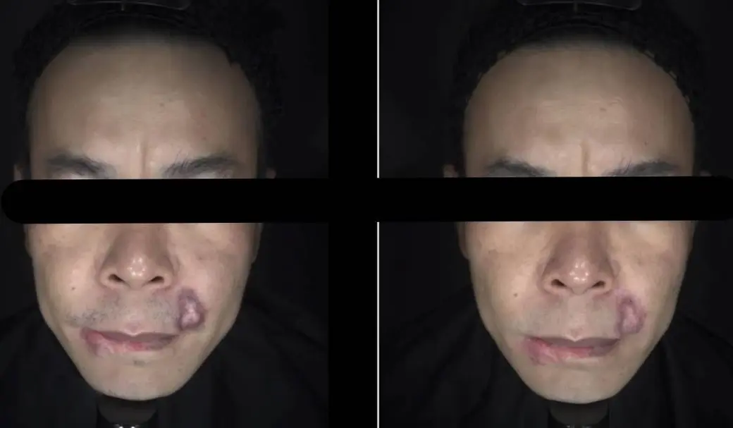 臨床照片兩張並排，同一位男性的正面臉部在治療前後對照，眼部以黑條遮蔽，左臉頰上的暗紅色斑塊顏色不同。
