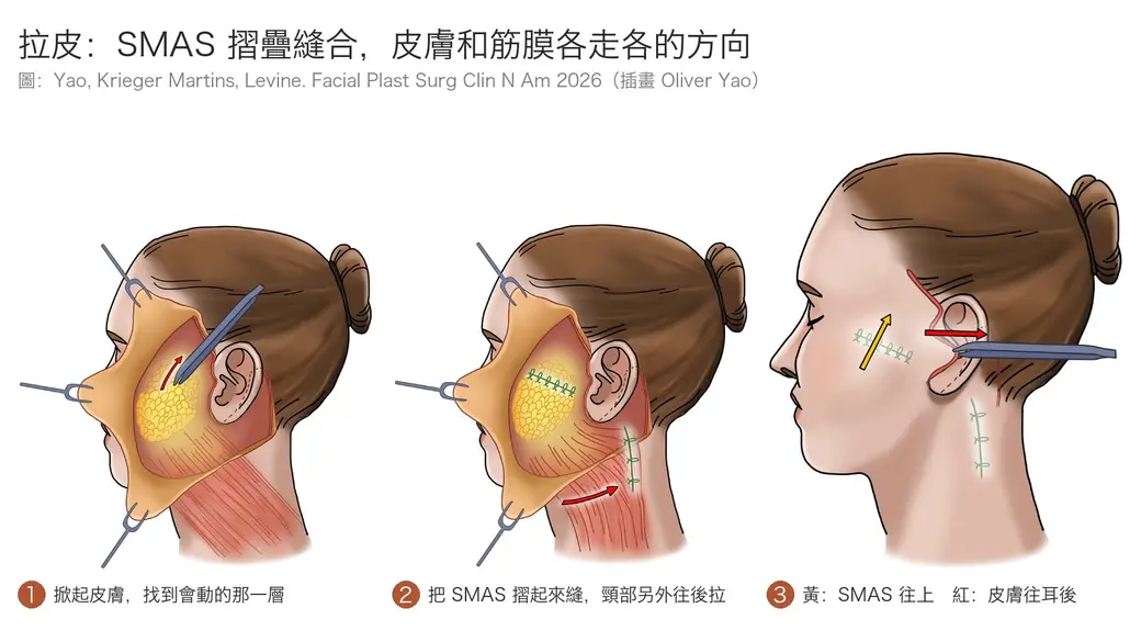 橫式封面，標題「拉皮：SMAS 摺疊縫合，皮膚和筋膜各走各的方向」，底下註明圖出自 Yao、Krieger Martins、Levine 2026 年論文、插畫 Oliver Yao。三張側臉手術示意插畫由左到右：第一張皮膚被拉鉤掀開，露出黃色脂肪與下方的 SMAS 層，鑷子夾住一點，紅色箭頭朝上，標示「掀起皮膚，找到會動的那一層」；第二張臉頰上多了一排綠色縫線，頸部的頸闊肌往耳後拉並縫合，標示「把 SMAS 摺起來縫，頸部另外往後拉」；第三張皮膚已蓋回，黃色箭頭朝上代表 SMAS 的方向、紅色箭頭朝耳後代表皮膚的方向，標示「黃：SMAS 往上　紅：皮膚往耳後」。
