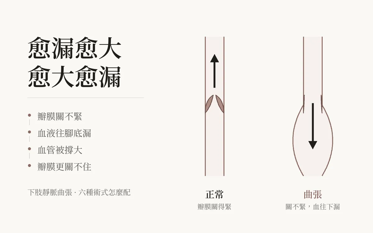 左邊是正常的靜脈，瓣膜關得緊、血往上流；右邊是曲張的靜脈，瓣膜關不緊、血往下漏、血管被撐大。